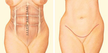 tummy-tuck-incision-front-abdomen-sutures.jpg